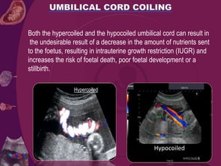 Both the hypercoiled and the hypocoiled umbilical cord can result in
the undesirable result of a decrease in the amount of nutrients sent
to the foetus, resulting in intrauterine growth restriction (IUGR) and
increases the risk of foetal death, poor foetal development or a
stillbirth.
Hypercoiled
Hypocoiled
 