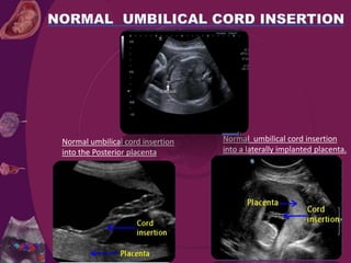 Normal umbilical cord insertion
into a laterally implanted placenta.
Normal umbilical cord insertion
into the Posterior placenta
 