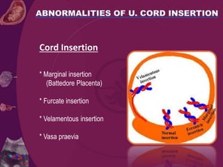 Cord Insertion
* Marginal insertion
(Battedore Placenta)
* Furcate insertion
* Velamentous insertion
* Vasa praevia
 