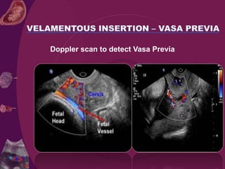 Doppler scan to detect Vasa Previa
 