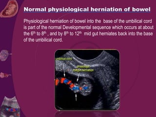 Physiological herniation of bowel into the base of the umbilical cord
is part of the normal Developmental sequence which occurs at about
the 6th to 8th , and by 8th to 12th mid gut herniates back into the base
of the umbilical cord.
 