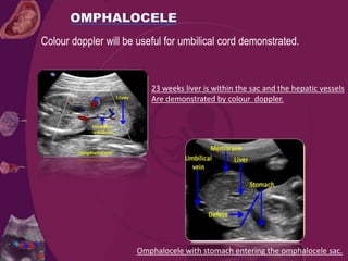 Colour doppler will be useful for umbilical cord demonstrated.
Omphalocele with stomach entering the omphalocele sac.
23 weeks liver is within the sac and the hepatic vessels
Are demonstrated by colour doppler.
 