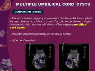 • This second trimester pregnancy shows evidence of multiple umbilical cord cysts (in
this case, there are two umbilical cord cysts). The colour doppler ultrasound images
show anechoic cystic structures with absence of flow, suggesting umbilical
cord cysts .
• Associated with increased morbidity and mortality for the fetus .
• Higher risk of aneuploidy.
ULTRASOUND IMAGES
 
