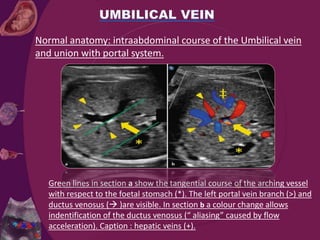 Green lines in section a show the tangential course of the arching vessel
with respect to the foetal stomach (*). The left portal vein branch (>) and
ductus venosus ( )are visible. In section b a colour change allows
indentification of the ductus venosus (“ aliasing” caused by flow
acceleration). Caption : hepatic veins (+).
Normal anatomy: intraabdominal course of the Umbilical vein
and union with portal system.
 