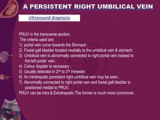 PRUV in the transverse section.
The criteria used are:
1) portal vein curve towards the Stomach.
2) Foetal gall bladder located medially to the umbilical vein & stomach.
3) Umbilical vein is abnormally connected to right portal vein instead to
the left portal vein.
4) Colour doppler is necessary .
5) Usually detected in 2nd to 3rd trimester.
6) An intrahepatic persistent right umbilical vein may be seen .
7) Abnormally connected to right portal vein and foetal gall bladder is
positioned medial to PRUV.
PRUV can be intra & Extrahepatic.The former is much more commoner.
Ultrasound diagnosis
 