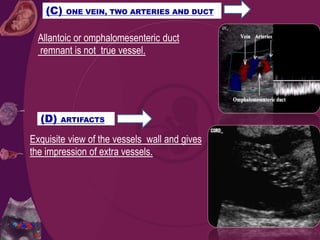 Allantoic or omphalomesenteric duct
remnant is not true vessel.
(C) ONE VEIN, TWO ARTERIES AND DUCT
(D) ARTIFACTS
Exquisite view of the vessels wall and gives
the impression of extra vessels.
 