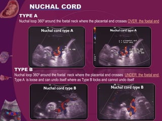 TYPE A
Nuchal loop 3600 around the foetal neck where the placental end crosses OVER the foetal end
TYPE B
Nuchal loop 3600 around the foetal neck where the placental end crosses UNDER the foetal end.
Type A is loose and can undo itself where as Type B locks and cannot undo itself
 
