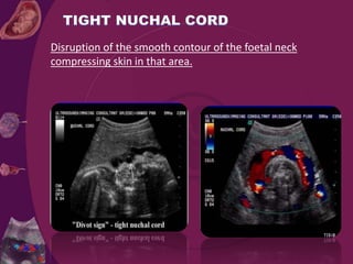 Disruption of the smooth contour of the foetal neck
compressing skin in that area.
 