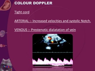Tight cord
ARTERIAL :- Increased velocities and systolic Notch.
VENOUS :- Prestenotic dialatation of vein
 