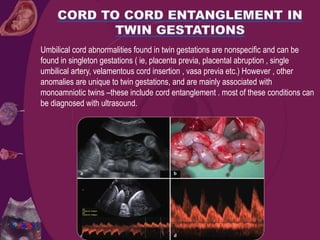 Umbilical cord abnormalities found in twin gestations are nonspecific and can be
found in singleton gestations ( ie, placenta previa, placental abruption , single
umbilical artery, velamentous cord insertion , vasa previa etc.) However , other
anomalies are unique to twin gestations, and are mainly associated with
monoamniotic twins –these include cord entanglement . most of these conditions can
be diagnosed with ultrasound.
 