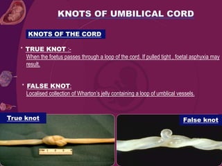 KNOTS OF THE CORD
* TRUE KNOT :-
When the foetus passes through a loop of the cord. If pulled tight , foetal asphyxia may
result.
* FALSE KNOT:
Localised collection of Wharton’s jelly containing a loop of umblical vessels.
True knot False knot
 