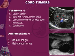 Angiomyxoma 
1. Usually benign .
2. Hetrogenous mass
Teratoma -
1. Usually benign
2. Solid with / without cystic areas
3. Contains tissue from all three germ
cells types.
4. Calcification.
 