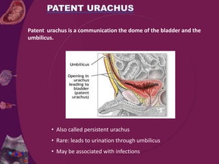 Patent urachus is a communication the dome of the bladder and the
umbilicus.
• Also called persistent urachus
• Rare: leads to urination through umbilicus
• May be associated with infections
 