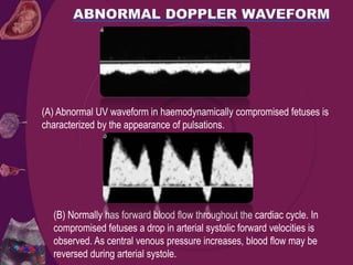 (B) Normally has forward blood flow throughout the cardiac cycle. In
compromised fetuses a drop in arterial systolic forward velocities is
observed. As central venous pressure increases, blood flow may be
reversed during arterial systole.
(A) Abnormal UV waveform in haemodynamically compromised fetuses is
characterized by the appearance of pulsations.
 
