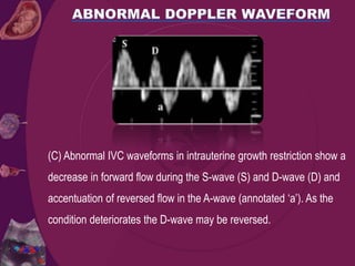 (C) Abnormal IVC waveforms in intrauterine growth restriction show a
decrease in forward flow during the S-wave (S) and D-wave (D) and
accentuation of reversed flow in the A-wave (annotated ‘a’). As the
condition deteriorates the D-wave may be reversed.
 