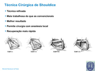Técnica Cirúrgica de Shouldice Técnica refinada Mais trabalhosa do que as convencionais Melhor resultado Permite cirurgia com anestesia local Recuperação mais rápida 