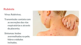 Rubéola
Vírus: Rubivírus;
Transmissão: contato com
as secreções das vias
respiratórias e através
da placenta;
Sintomas: lesões
avermelhadas na pele;
febre e nódulos
inchados.
 