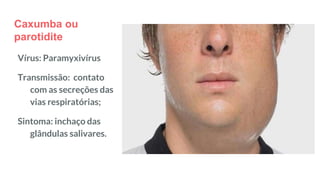 Caxumba ou
parotidite
Vírus: Paramyxivírus
Transmissão: contato
com as secreções das
vias respiratórias;
Sintoma: inchaço das
glândulas salivares.
 