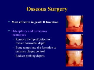 Osseous Surgery
 Most effective in grade II furcation
 Osteoplasty and ostectomy
techniques
– Remove the lip of defect to
reduce horizontal depth
– Bone ramps into the furcation to
enhance plaque control
– Reduce probing depths
 