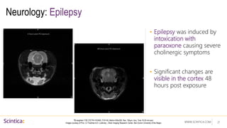 WWW.SCINTICA.COM
Neurology: Epilepsy
• Epilepsy was induced by
intoxication with
paraoxone causing severe
cholinergic symptoms
• Significant changes are
visible in the cortex 48
hours post exposure
21
T2 weighted: FSE (TE/TR=74/3400, FOV=50, Matrix=256x256, Res. 195µm, Acq. Time 16:30 min:sec)
Images courtesy of Prov. A. Friedman & S. Lublinsky – Brain Imaging Research Center, Ben-Gurion University of the Negev
3 hours post PO exposure
48 hours post PO exposure
 