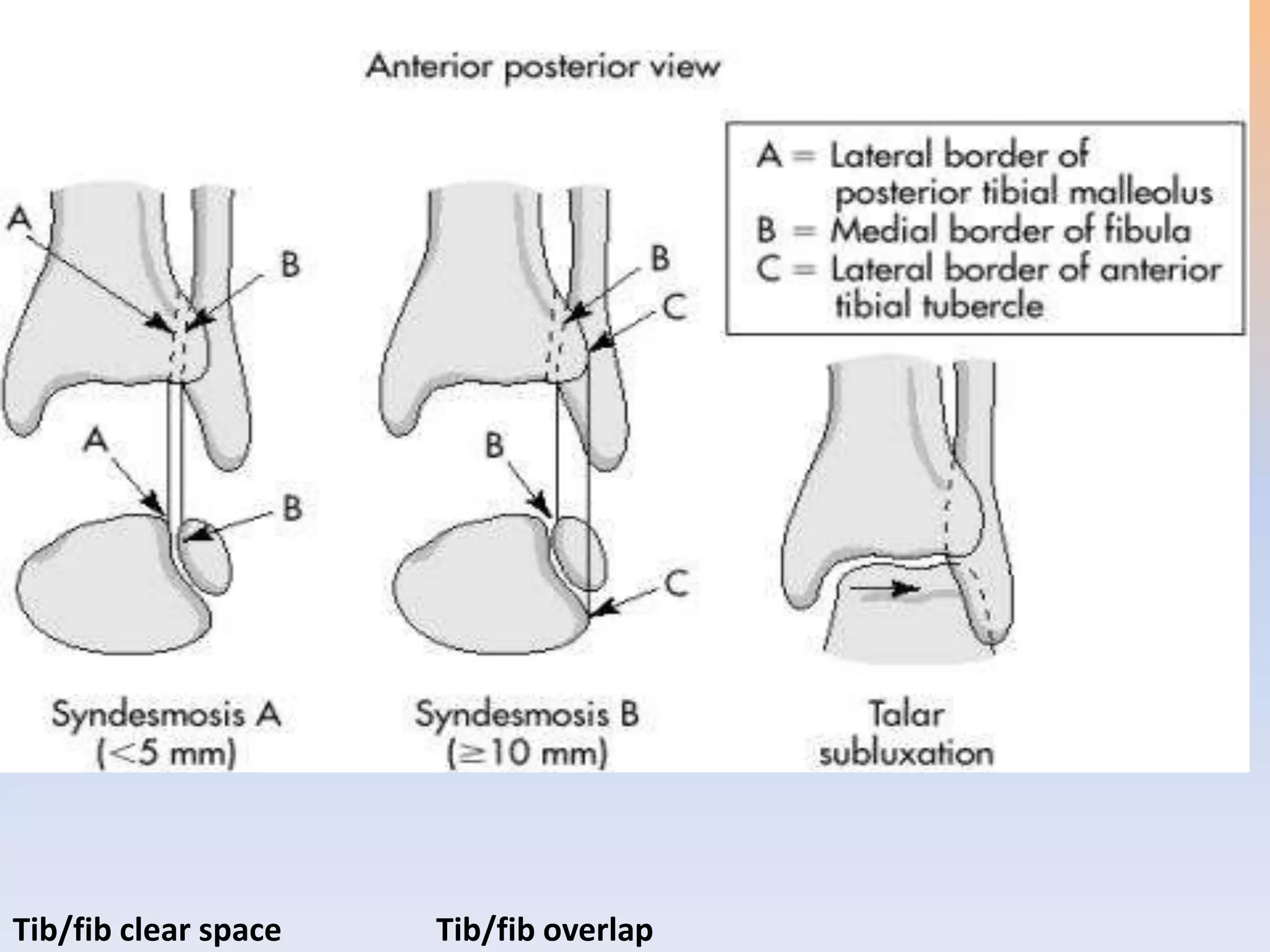 ANKLE FRACTURES | PPTX