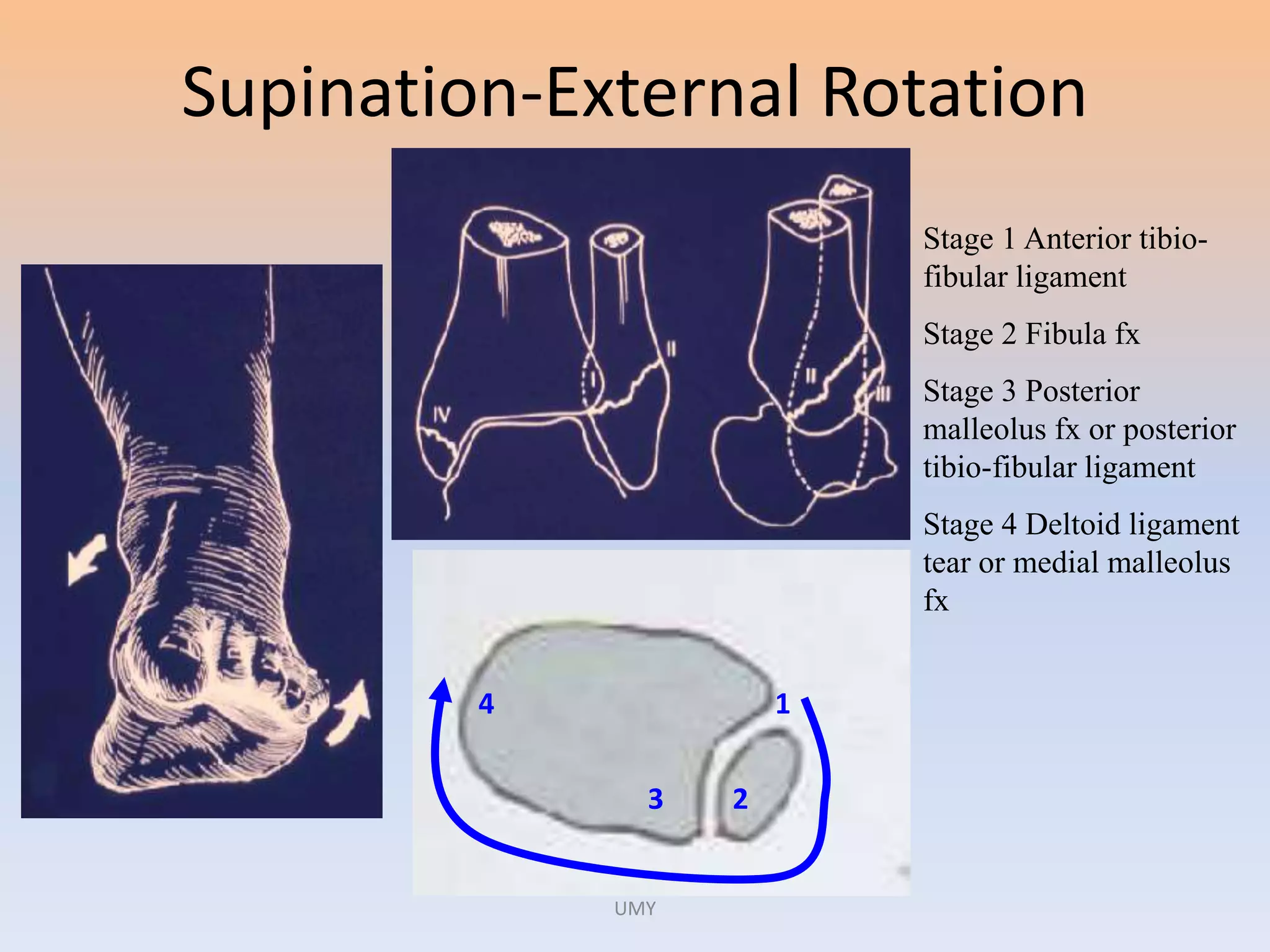 ANKLE FRACTURES | PPTX