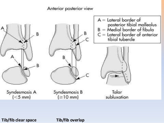 ANKLE FRACTURES