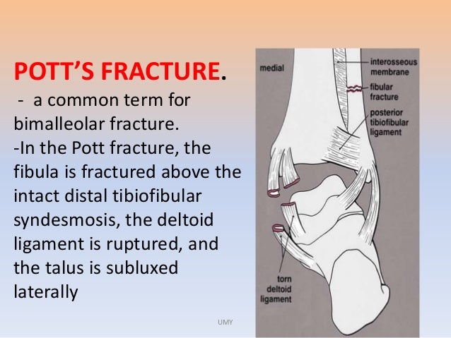 pott s fracture