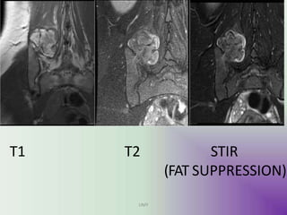 T1 T2 STIR
(FAT SUPPRESSION)
UMY
 