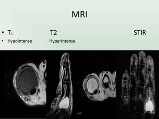 MRI
STIR
• T1
• Hypointense
T2
Hyperintense
UMY
 
