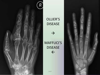OLLIER’S
DISEASE

MAFFUCI’S
DISEASE

UMY
 