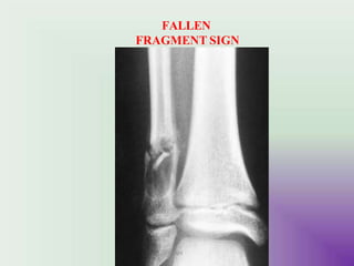 FALLEN
FRAGMENT SIGN
UMY
 