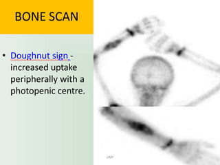 BONE SCAN
• Doughnut sign -
increased uptake
peripherally with a
photopenic centre.
UMY
 