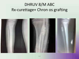 DHRUV 8/M ABC
Rx-curettage+ Chron os grafting
UMY
 