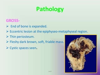 Pathology
GROSS-
 End of bone is expanded.
 Eccentric lesion at the epiphyseo-metaphyseal region.
 Thin periosteum.
 Fleshy dark brown, soft, friable mass.
 Cystic spaces seen.
UMY
 