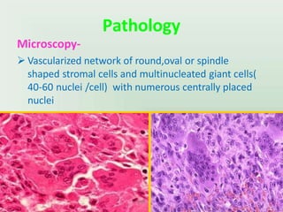 Pathology
Microscopy-
 Vascularized network of round,oval or spindle
shaped stromal cells and multinucleated giant cells(
40-60 nuclei /cell) with numerous centrally placed
nuclei
UMY
 