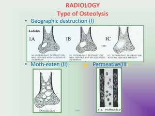 RADIOLOGY
Type of Osteolysis
• Geographic destruction (I)
• Moth-eaten (II) Permeative(III)
Lodwick
1A 1B 1C
UMY
 