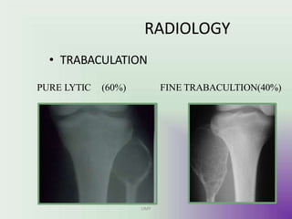 RADIOLOGY
• TRABACULATION
PURE LYTIC (60%) FINE TRABACULTION(40%)
UMY
 