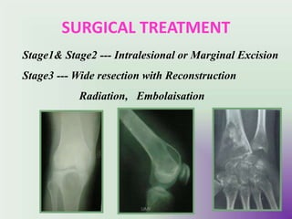 SURGICAL TREATMENT
Stage1& Stage2 --- Intralesional or Marginal Excision
Stage3 --- Wide resection with Reconstruction
Radiation, Embolaisation
UMY
 