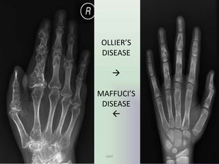OLLIER’S
DISEASE

MAFFUCI’S
DISEASE

UMY
 