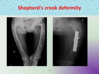 Shepherd's crook deformity
UMY
 