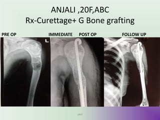 ANJALI ,20F,ABC
Rx-Curettage+ G Bone grafting
PRE OP IMMEDIATE POST OP FOLLOW UP
UMY
 