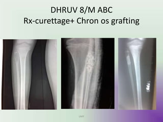 DHRUV 8/M ABC
Rx-curettage+ Chron os grafting
UMY
 