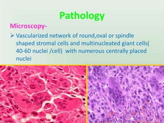 Pathology
Microscopy-
 Vascularized network of round,oval or spindle
shaped stromal cells and multinucleated giant cells(
40-60 nuclei /cell) with numerous centrally placed
nuclei
UMY
 