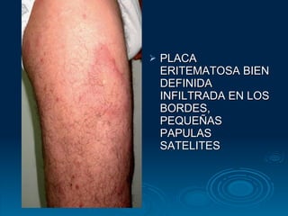 PLACA ERITEMATOSA BIEN DEFINIDA INFILTRADA EN LOS BORDES, PEQUEÑAS PAPULAS SATELITES 