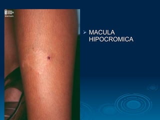 MACULA HIPOCROMICA 
