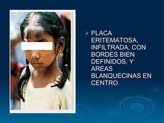 PLACA ERITEMATOSA, INFILTRADA, CON BORDES BIEN DEFINIDOS, Y AREAS BLANQUECINAS EN CENTRO 