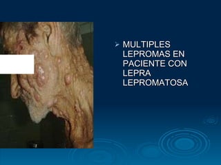 MULTIPLES LEPROMAS EN PACIENTE CON LEPRA LEPROMATOSA 
