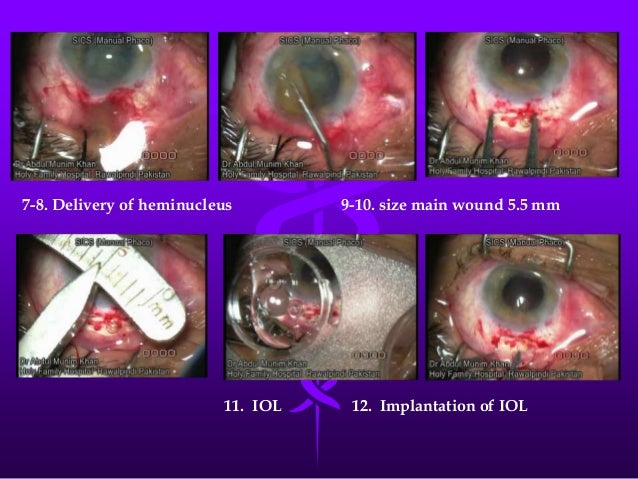 cataract incision suture unaided surge