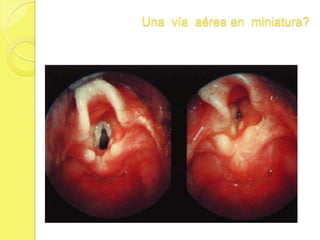 Valoración de  la  vía  aérea en los  niños